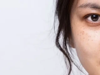 4 Cara Alami Hilangkan Flek Hitam di Wajah