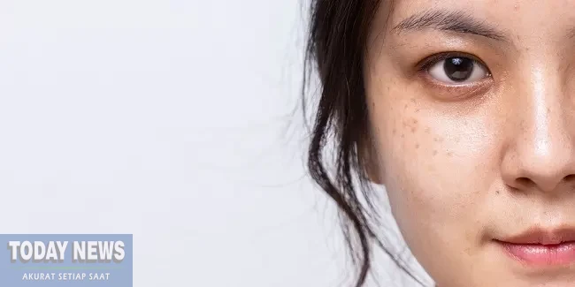 4 Cara Alami Hilangkan Flek Hitam di Wajah