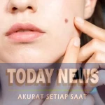 5 Penyebab Noda Hitam Bekas Jerawat