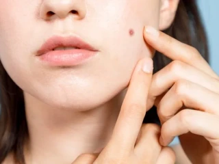 5 Penyebab Noda Hitam Bekas Jerawat